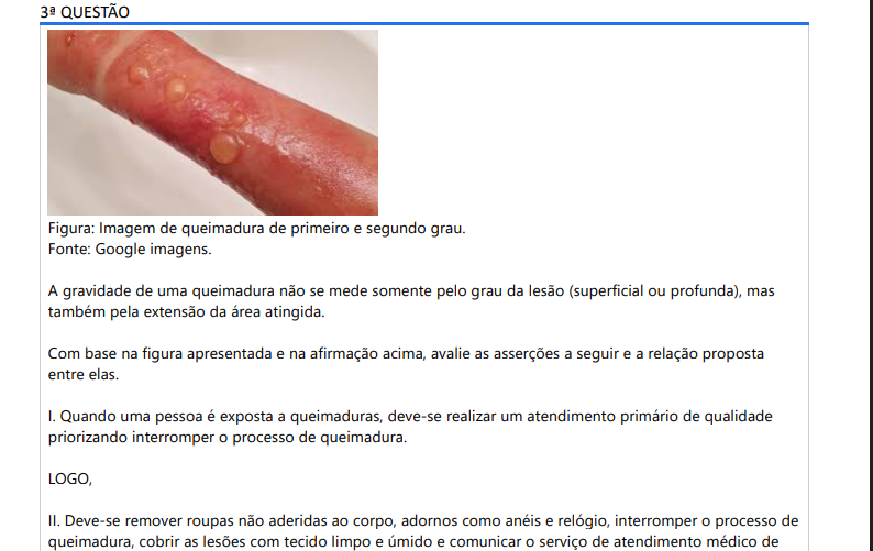 3ª QUESTÃO Figura: Imagem de queimadura de primeiro e segundo grau. Fonte: Google imagens. A gravidade de uma queimadura não se mede somente pelo grau da lesão (superficial ou profunda), mas também pela extensão da área atingida. Com base na figura apresentada e na afirmação acima, avalie as asserções a seguir e a relação proposta entre elas. I. Quando uma pessoa é exposta a queimaduras, deve-se realizar um atendimento primário de qualidade priorizando interromper o processo de queimadura. LOGO, II. Deve-se remover roupas não aderidas ao corpo, adornos como anéis e relógio, interromper o processo de queimadura, cobrir as lesões com tecido limpo e úmido e comunicar o serviço de atendimento médico de urgência. A respeito dessas asserções, assinale a opção correta ALTERNATIVAS a) As asserções I e II proposições são falsas. b) A asserção I é uma proposição verdadeira e a II é uma proposição falsa. c) A asserção I é uma proposição falsa e a II é uma proposição verdadeira. d) As asserções I e II são proposições verdadeiras e complementares. e) As asserções I e II são proposições verdadeiras mas não apresentam relação entre si.