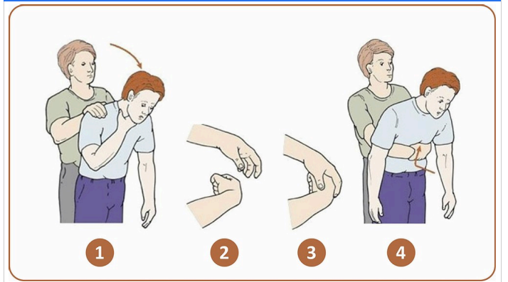 7ª QUESTÃO A manobra de Heimlich é um procedimento rápido de primeiros socorros para tratar asfixia devido à obstrução das vias respiratórias superiores por objetos estranhos como alimento, brinquedo ou outro objeto. Disponível em: . Acesso em: 15 nov. 2020.Considerando a sequência de atendimento a ser seguida, avalie as afirmações: I. Ao identificar um adulto com obstrução de vias aéreas, posicione-se por trás e enlace a vítima com os braços ao redor do abdome, caso ela esteja consciente. II. Uma das mãos permanece fechada sobre a chamada “boca do estômago” (região epigástrica).III. A outra mão comprime a primeira, ao mesmo tempo em que empurra a “boca do estômago” para dentro e para cima, como se quisesse levantar a vítima do chão. IV. Faça movimentos de compressão para dentro e para cima (como uma letra "J"), até que a vítima elimine o corpo estranho. É correto o que se afirmar em: ALTERNATIVAS a) I, apenas. b) I e II apenas. c) I, II e III apenas. d) II, III e IV apenas. e) I, II, III e IV.